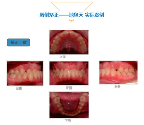 牙齿矫正