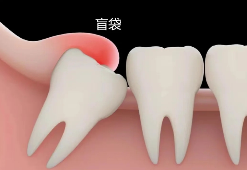 智齿盲袋,你了解多少? 智齿盲袋,你了解多少?