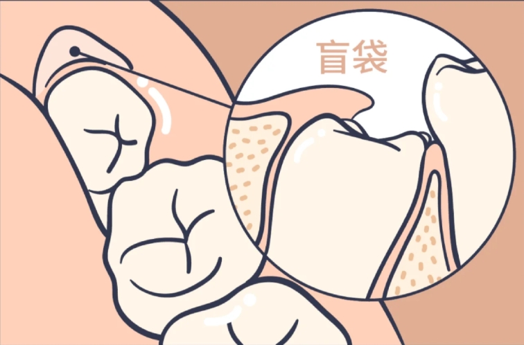 智齿盲袋到底拔 or 不拔？