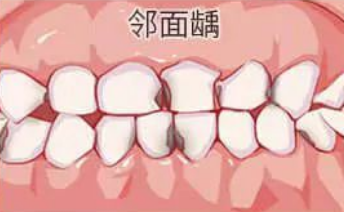 牙齿缝隙里的隐形杀手（邻面龋），一坏就是两颗牙！