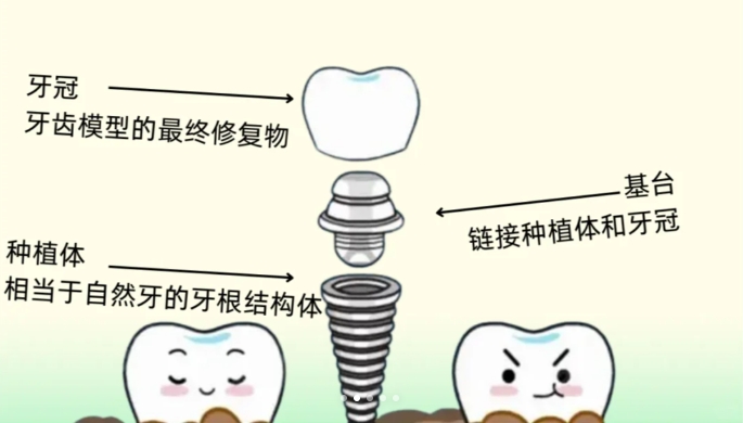 种植知识科普 | 什么是基台？